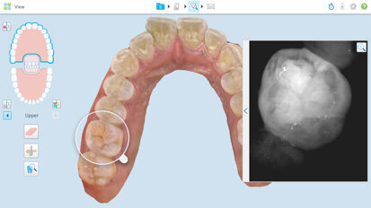 מחקר קליני מאמת כלי עזר חדש לאיתור וניטור נגעי עששת אינטרה -פרוקסימליים