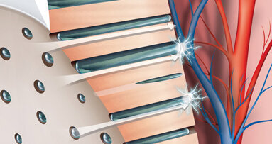 Ipersensibilità dentinale semplificata