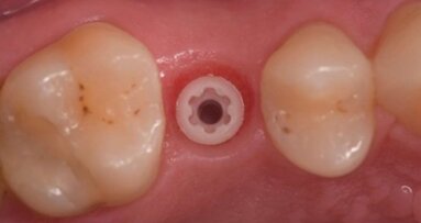Impianti in Zirconia: una diversa risposta biologica al biofilm batterico