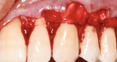 Trattamento di recessioni gengivali multiple mediante tecnica MCAF associata all’utilizzo di una matrice tridimensionale collagenica