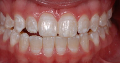 Los efectos adversos del aclaramiento dental