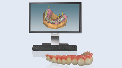 Creación segura, rápida y sencilla de puentes sobre implantes