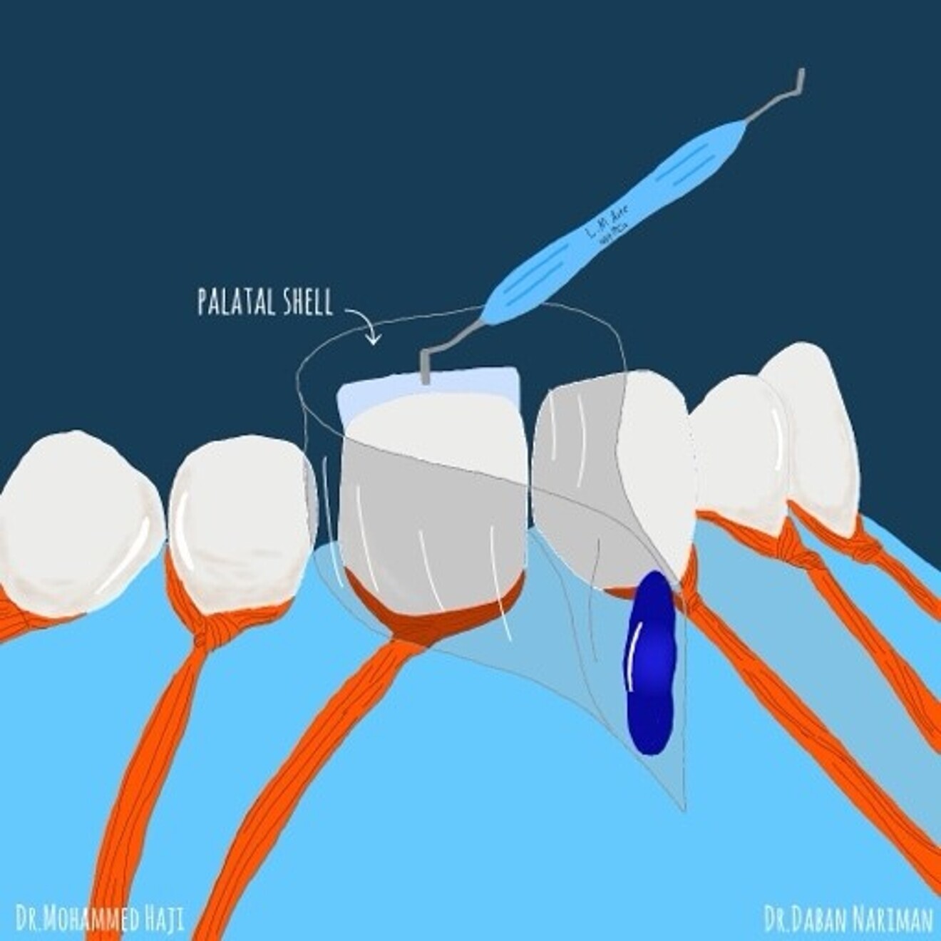 Fig. 1c: Create the Free Hand palatal shell with  translucent shade of Injectable composite.