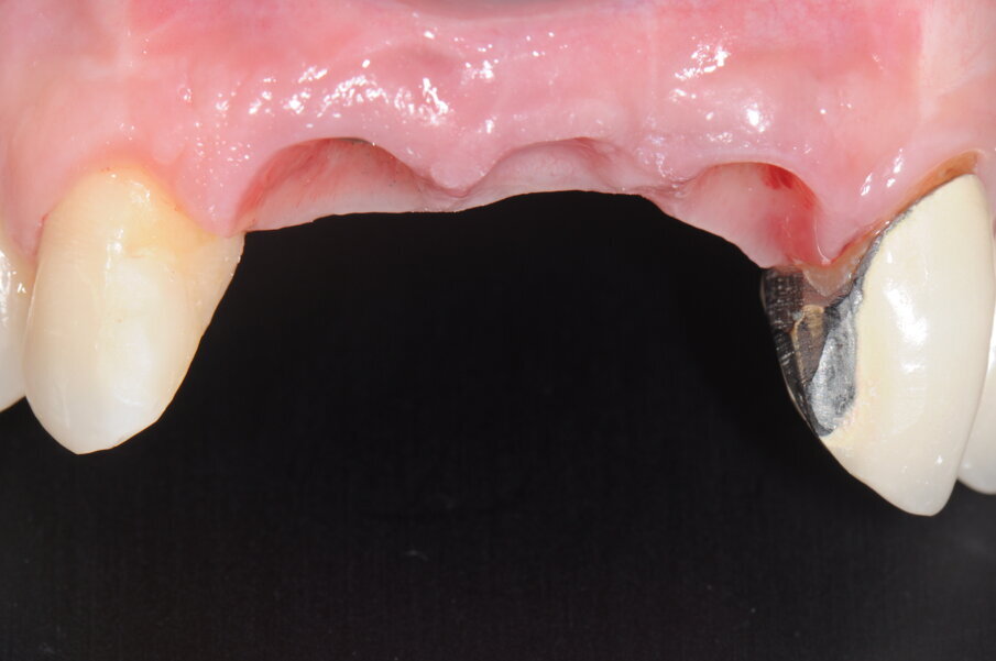 Figg. 25a, 25b - Valutazione dei tessuti molli in visione frontale e occlusale in assenza di protesi definitiva.