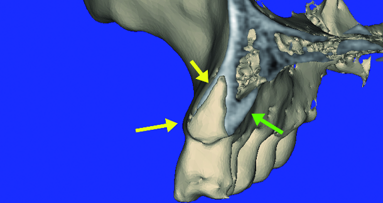 Improved CBCT diagnostic acuity with the ‘Lip-Lift’ technique