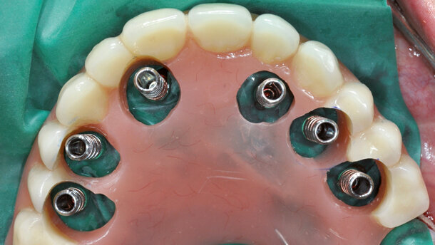 Restauro immediato su impianti nel mascellare edentulo
