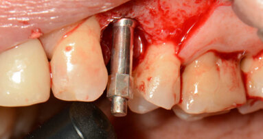 „Neprodáváme implantáty“ – rozvaha nad okamžitým zatížením dentálních implantátů