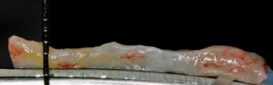 Fig. 3: Harvested Connective Tissue (CT) graft. An excess of adipose tissue in the graft leads to increased shrinkage. 