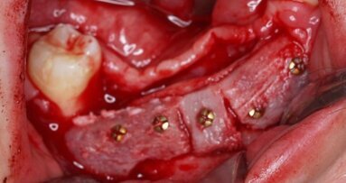 Uraz powybuchowy II stopnia – leczenie złamania żuchwy, rekonstrukcja kości i odbudowa implantologiczna