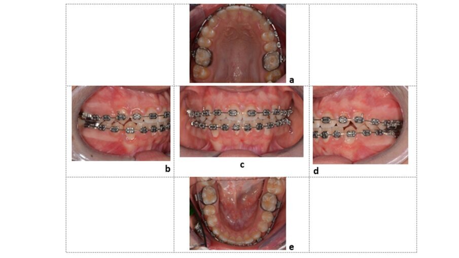 Fig. 8_Foto finali intraorali del paziente: Elemento 4.3, recuperato al centro dell’arcata, osservato da vista occlusale superiore (a), vista laterale destra (b), vista frontale (c), laterale sinistra vista (d) e vista occlusale inferiore (e).