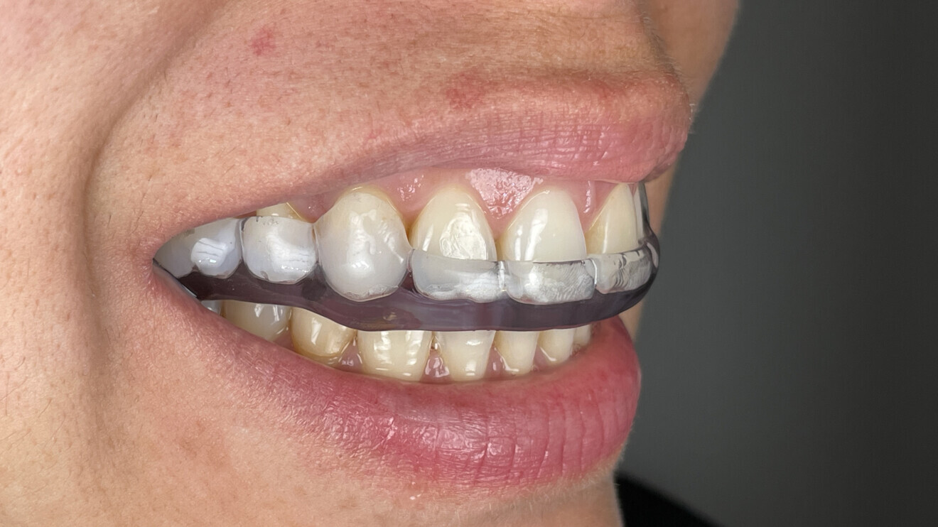 Figs. 10a–c: Ready splint in patient’s mouth.