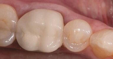 Ceramika – uzasadnienie wyboru materiału