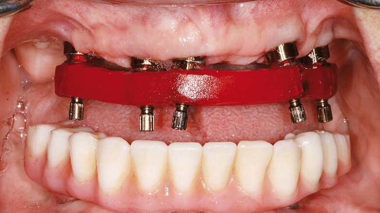 Nepřímá metoda pro ošetřování prostřednictvím provizorií