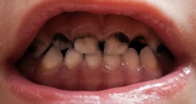 Les bactéries cariogènes peuvent persister chez les enfants après le traitement de caries