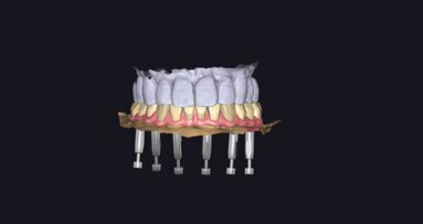 Carico immediato  mandibolare con approccio digitale