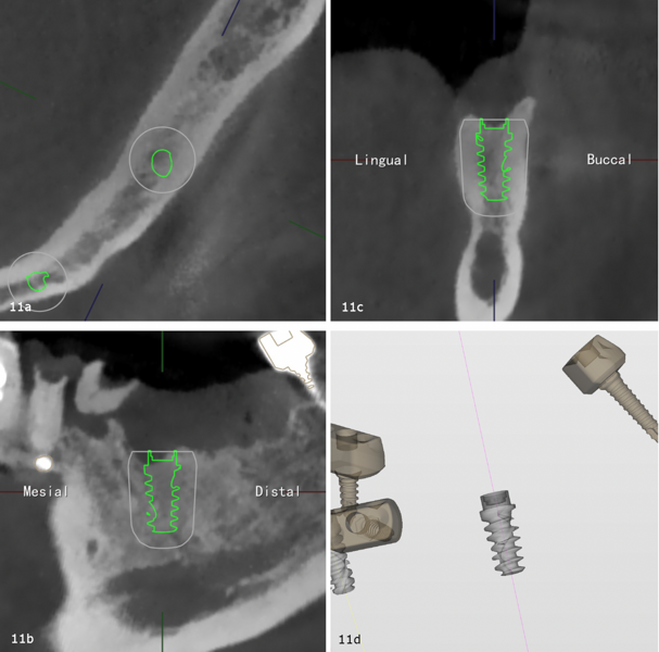 Figs. 11a–d: Robotic treatment plan showing the planned implant position in multiplanar and 3D views (a–c) and its spatial relationship to the fiducial markers (d).