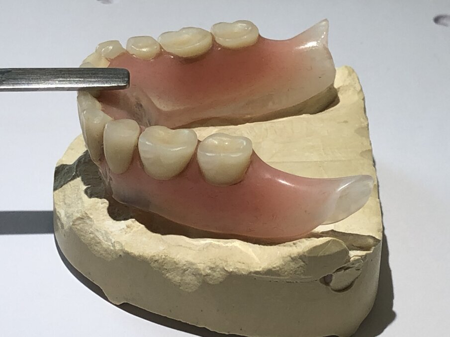 Afbeelding 6. Onderkaakprothese zonder te kauwen.  