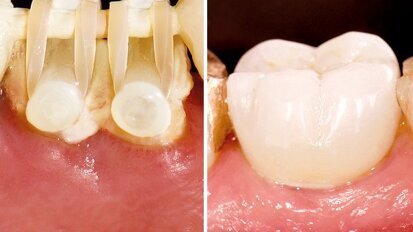 Webinar thematisiert Extrusionstherapie Webinar thematisiert Extrusionstherapie
