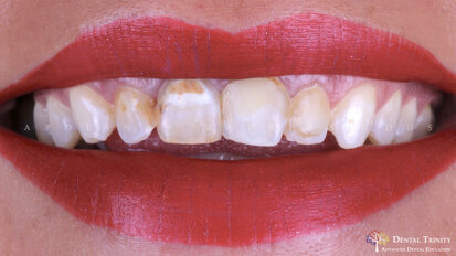 Carillas de Mínima Invasión