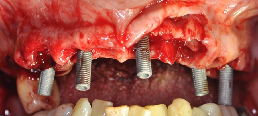 Fig. 3_Foto intra-orale durante il posizionamento degli impianti nell’arcata superiore.
