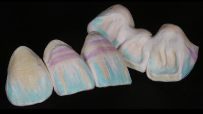 The dream team: Effect liquids and micro-layering on highly aesthetic zirconia