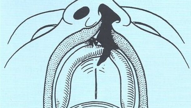 Recenti sviluppi sulla Genetica delle Schisi Orofacciali