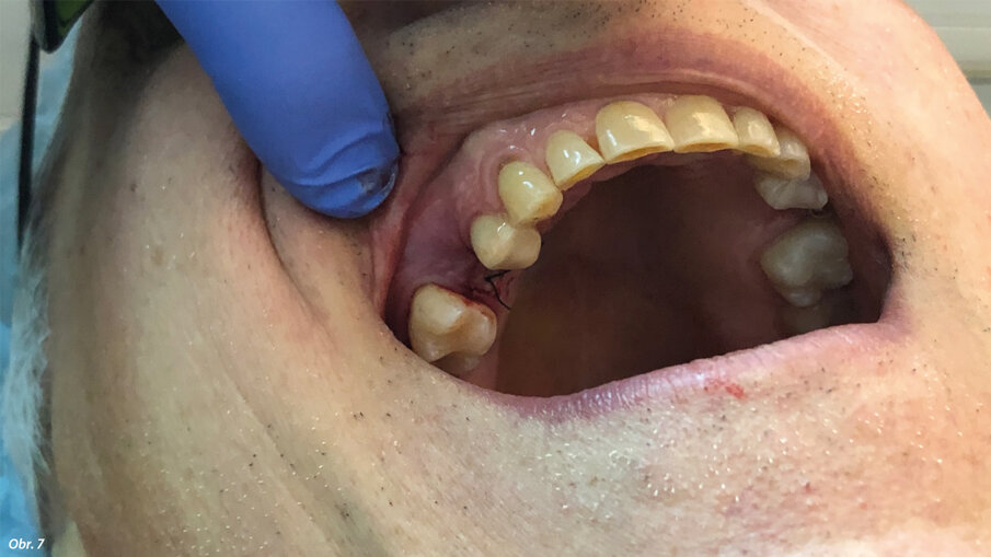 Klinická situace po zákroku.