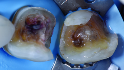Complex direct ORMOCER composite restorations in the posterior region