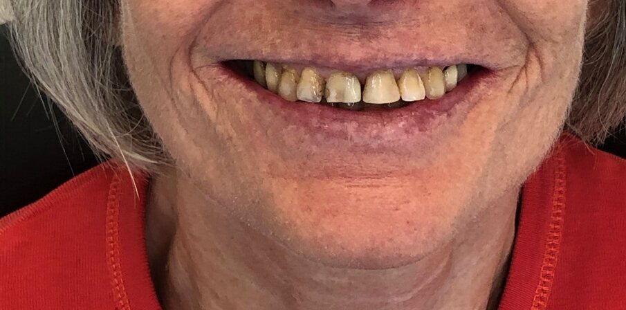 De beginsituatie: we zien sterk versleten centrale snijtanden met verkeerde lengte-breedte-proporties met veel verschillende tand-tinten.