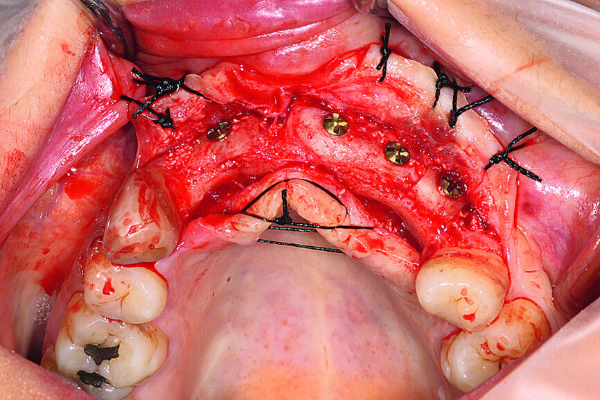 Fig. 13: The reopened site showing correct graft integration, a notable increase in cortical bone and excellent vascularity.