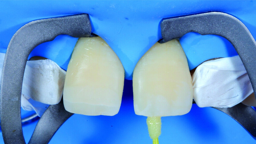 Fig. 15: Application of the adhesive luting agent to the surfaces to be bonded.