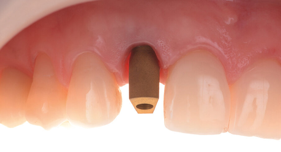 Fig. 13. Clinical situation with scan body