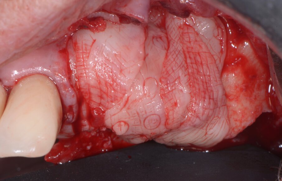 Fig. 9 - Membrane di PRF a protezione dell’innesto.