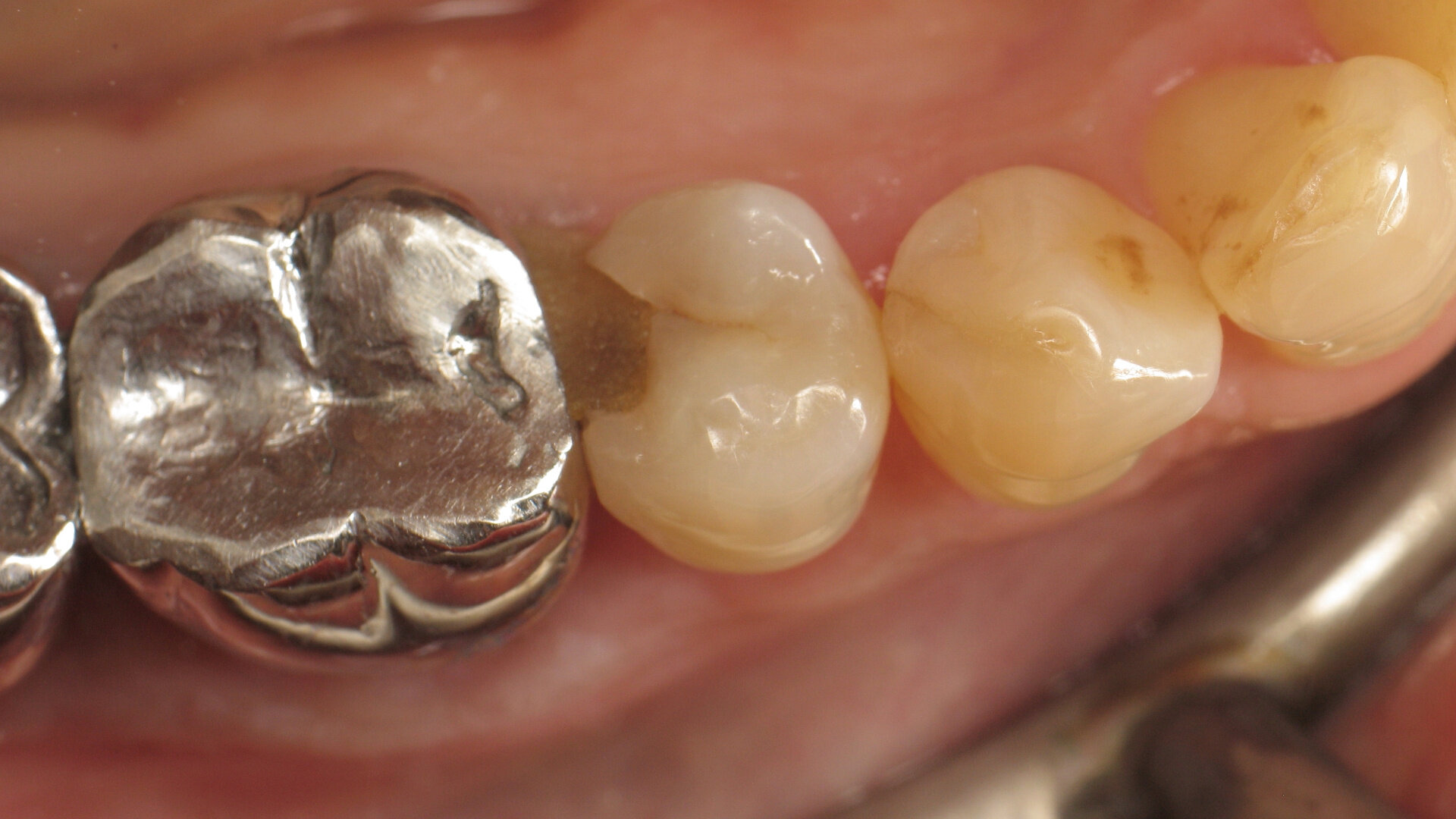 Class II restoration with thermo-viscous composite