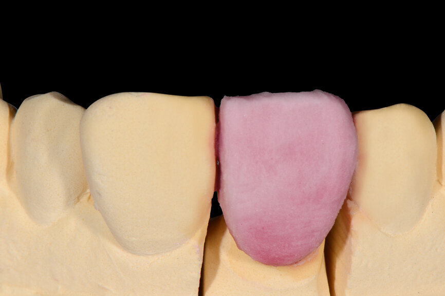 Fig. 6. Estratificación de corona completa con DENTINE 2M1 antes del cut back. 