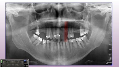 Minimalnie inwazyjne rozwiązania implantoprotetyczne w zaniku poziomym kości szczęki i żuchwy