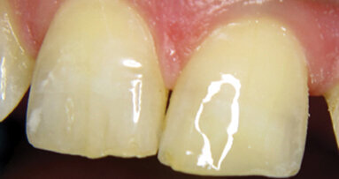 No-flow flowables for ‘Beautifil’ restorations