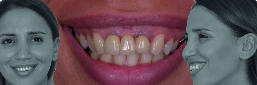 Fig. 1 : Vue extra-orale préopératoire.