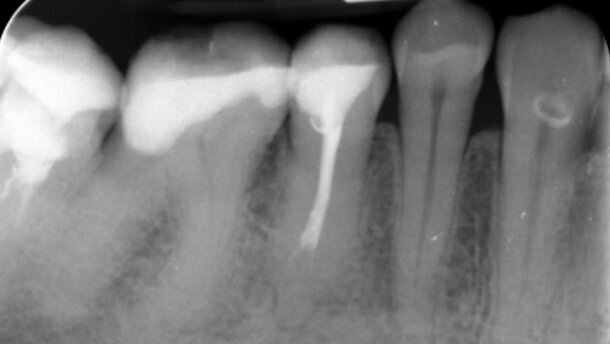 Zastosowanie lasera Er:YAG w procedurach udrażniania kanałów korzeniowych