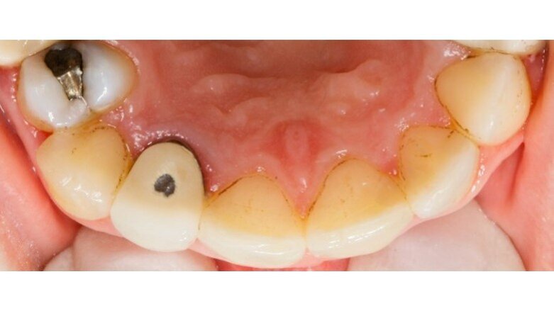 L’utilizzo dei probiotici nel controllo delle black stains