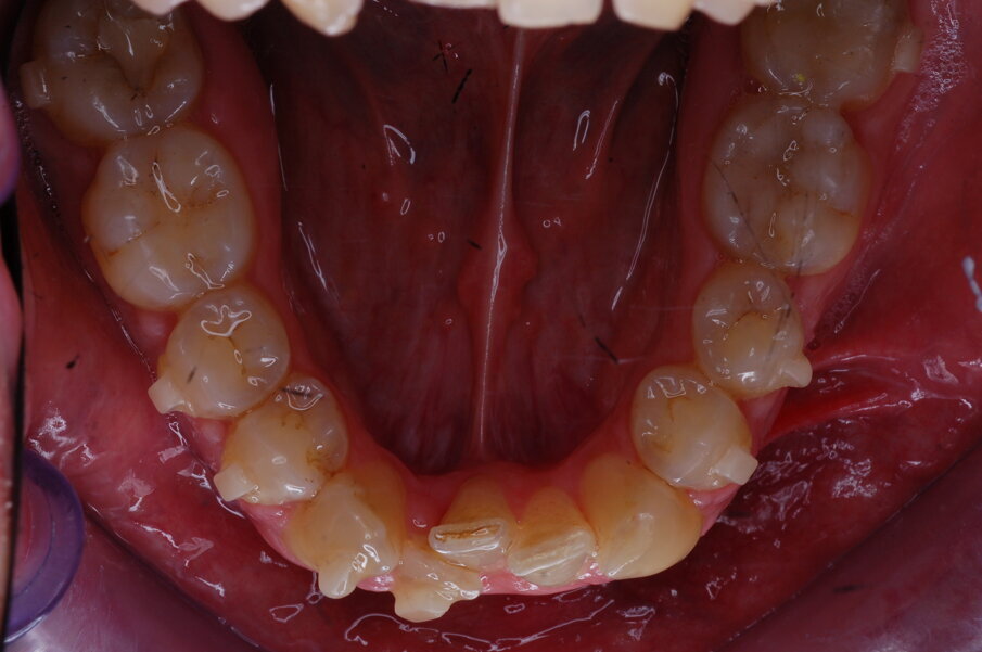 Figg. 37-44_Fotografie intraorali in sequenza che illustrano il progressivo allineamento dell’arco mandibolare.