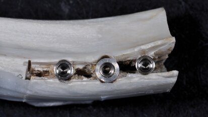 Intérêt de l’implant Fratex en présence de crêtes fines