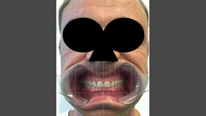 Fig. 4. Protocolo DSD: imagen del paciente sonriendo con un retractor de labios y mejillas.