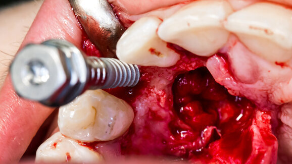 Nano-coating effective in reducing peri-implantitis risk