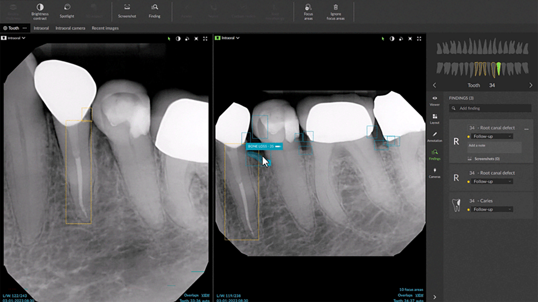 2D-Zahnbefund in DTX. © DEXIS