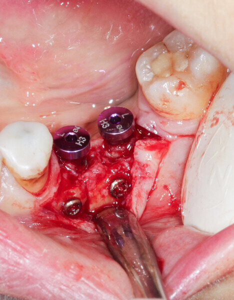 Fig. 8: Healing abutments were connected to the implants.