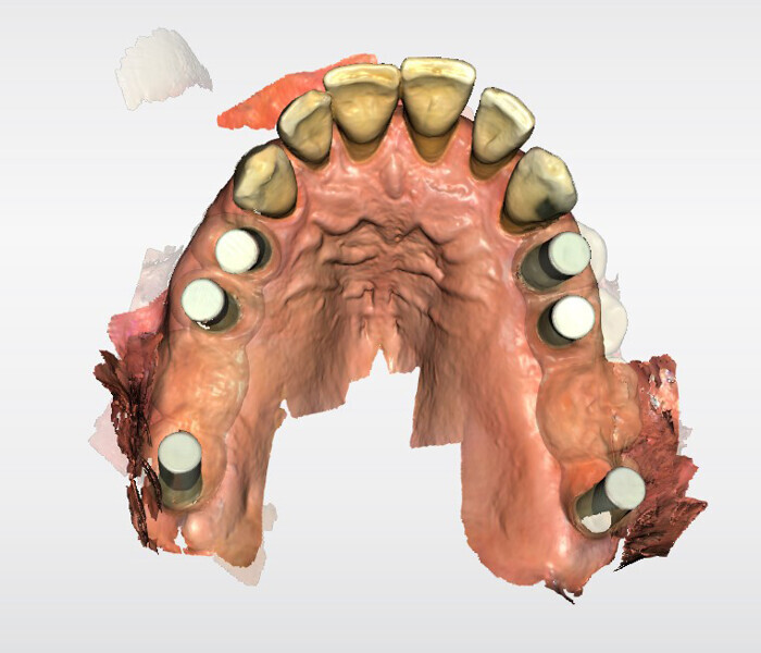 Fig. 9: Intra-oral scan with the Atlantis IO FLO-S scan bodies inserted.