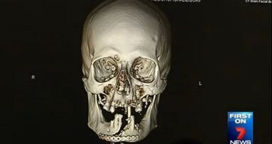 Succesvolle gezichtsreconstructie na ongeluk met kettingzaag