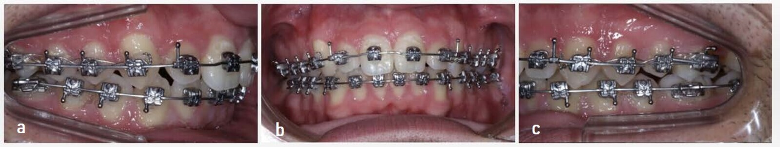 Figs. 15a–c: Distal archwire of the first premolar cut. 