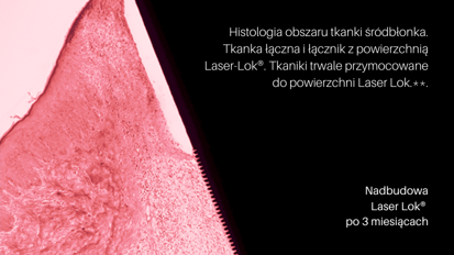 Unikatowa powierzchnia Laser Lok® na implancie i nadbudowie!